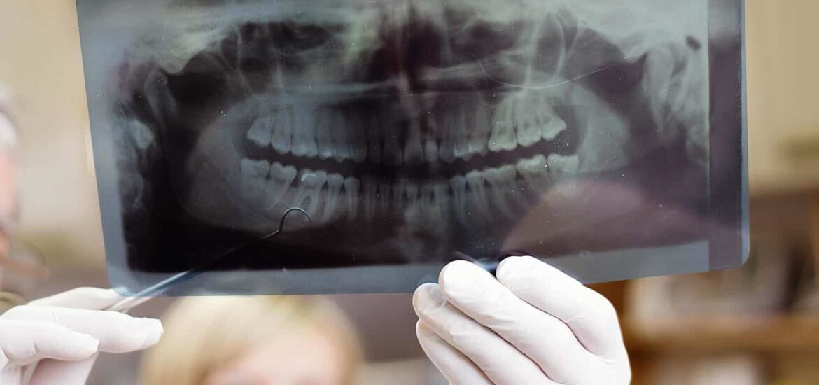 cavity formation in teeth