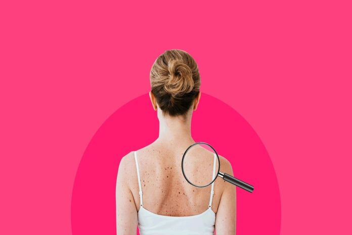 Consult Dermatologist