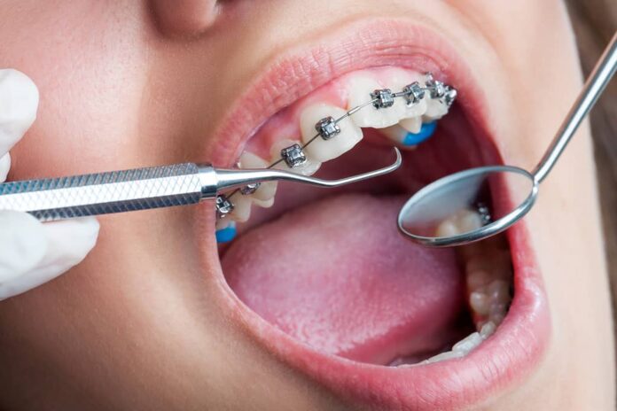 Dental Braces