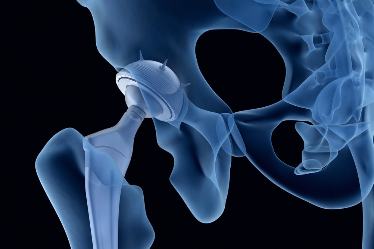 Hip Replacement Implant Types